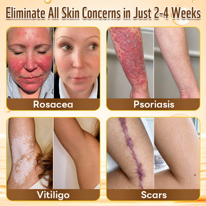One last chance! Grab this lucky find at 90% OFF to erase warts permanently!🔥 180-day money back guarantee! Act fast! HISKIN®