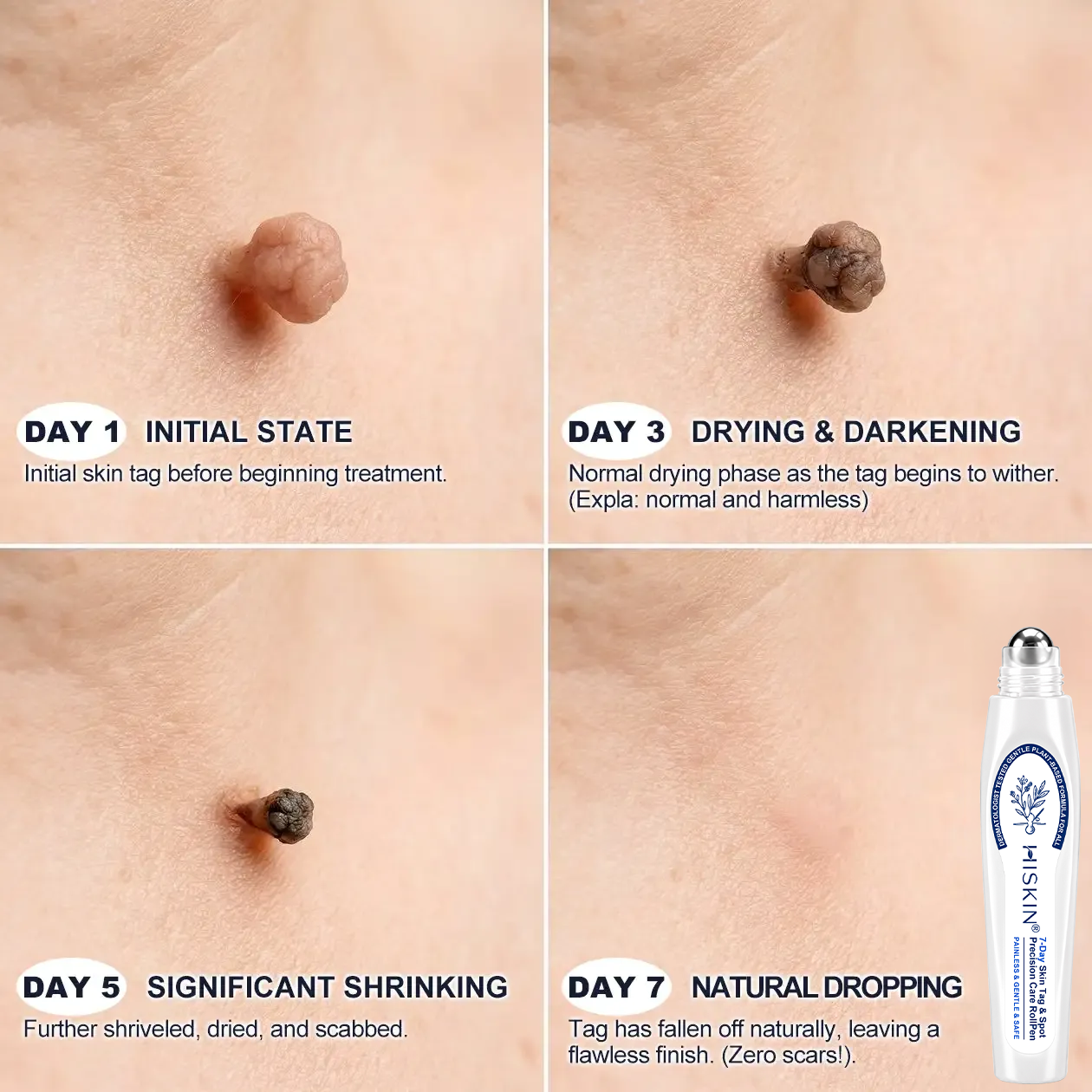 Only 7 Pack Left! Get an exclusive 80% discount on HISKIN® Rollerball Pen today! Say goodbye to embarrassing warts and skin tags in just 1 to 4 weeks. Don’t miss out—Flash Renewal Offer! Plus, enjoy a 180-day money-back guarantee. Act fast!