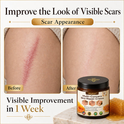 One last chance! Grab this lucky find at 90% OFF to erase warts permanently!🔥 180-day money back guarantee! Act fast! HISKIN®