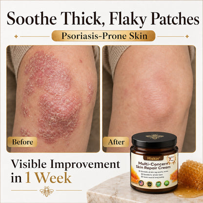 One last chance! Grab this lucky find at 90% OFF to erase warts permanently!🔥 180-day money back guarantee! Act fast! HISKIN®