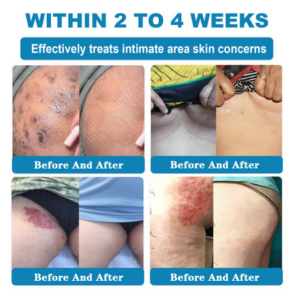 𝑶𝒏𝒍𝒚 4 Bottle! 𝑮𝒓𝒂𝒃 𝒂𝒏 𝒆𝒙𝒄𝒍𝒖𝒔𝒊𝒗𝒆 80% 𝒅𝒊𝒔𝒄𝒐𝒖𝒏𝒕 𝒏𝒐𝒘! 𝑲𝒆𝒆𝒑 𝒚𝒐𝒖𝒓 𝒔𝒌𝒊𝒏 𝒚𝒐𝒖𝒕𝒉𝒇𝒖𝒍 𝒂𝒏𝒅 𝒈𝒍𝒐𝒘𝒊𝒏𝒈 𝒊𝒏 𝒋𝒖𝒔𝒕 1 𝒕𝒐 4 𝒘𝒆𝒆𝒌𝒔. 𝑫𝒐𝒏’𝒕 𝒎𝒊𝒔𝒔 𝒚𝒐𝒖𝒓 𝒄𝒉𝒂𝒏𝒄𝒆—𝒕𝒉𝒊𝒔 𝒐𝒇𝒇𝒆𝒓 𝒘𝒐𝒏’𝒕 𝒄𝒐𝒎𝒆 𝒂𝒓𝒐𝒖𝒏𝒅 𝒂𝒈𝒂𝒊𝒏 𝒖𝒏𝒕𝒊𝒍 𝒏𝒆𝒙𝒕 𝒚𝒆𝒂𝒓. 180-𝒅𝒂𝒚 𝒎𝒐𝒏𝒆𝒚 𝒃𝒂𝒄𝒌 𝒈𝒖𝒂𝒓𝒂𝒏𝒕𝒆𝒆! HISKIN®