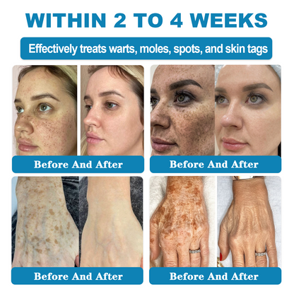 𝑶𝒏𝒍𝒚 4 Bottle! 𝑮𝒓𝒂𝒃 𝒂𝒏 𝒆𝒙𝒄𝒍𝒖𝒔𝒊𝒗𝒆 80% 𝒅𝒊𝒔𝒄𝒐𝒖𝒏𝒕 𝒏𝒐𝒘! 𝑲𝒆𝒆𝒑 𝒚𝒐𝒖𝒓 𝒔𝒌𝒊𝒏 𝒚𝒐𝒖𝒕𝒉𝒇𝒖𝒍 𝒂𝒏𝒅 𝒈𝒍𝒐𝒘𝒊𝒏𝒈 𝒊𝒏 𝒋𝒖𝒔𝒕 1 𝒕𝒐 4 𝒘𝒆𝒆𝒌𝒔. 𝑫𝒐𝒏’𝒕 𝒎𝒊𝒔𝒔 𝒚𝒐𝒖𝒓 𝒄𝒉𝒂𝒏𝒄𝒆—𝒕𝒉𝒊𝒔 𝒐𝒇𝒇𝒆𝒓 𝒘𝒐𝒏’𝒕 𝒄𝒐𝒎𝒆 𝒂𝒓𝒐𝒖𝒏𝒅 𝒂𝒈𝒂𝒊𝒏 𝒖𝒏𝒕𝒊𝒍 𝒏𝒆𝒙𝒕 𝒚𝒆𝒂𝒓. 180-𝒅𝒂𝒚 𝒎𝒐𝒏𝒆𝒚 𝒃𝒂𝒄𝒌 𝒈𝒖𝒂𝒓𝒂𝒏𝒕𝒆𝒆! HISKIN®