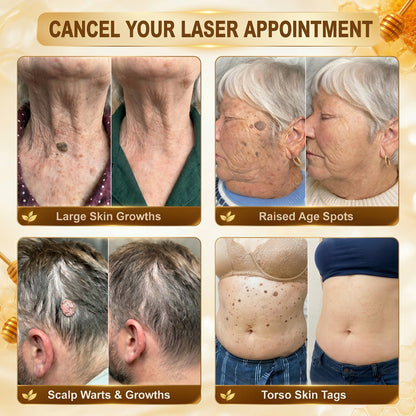 One last chance! Grab this lucky find at 90% OFF to erase warts permanently!🔥 180-day money back guarantee! Act fast! HISKIN®